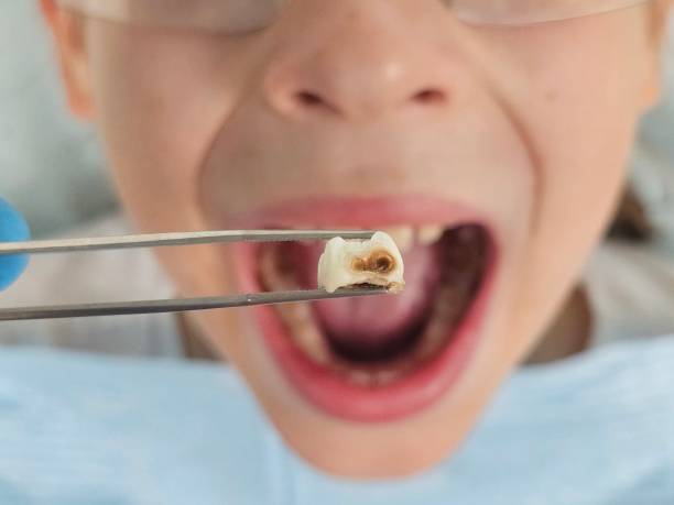 Best Emergency Dental Care for Abscessed Tooth in Muniz, TX